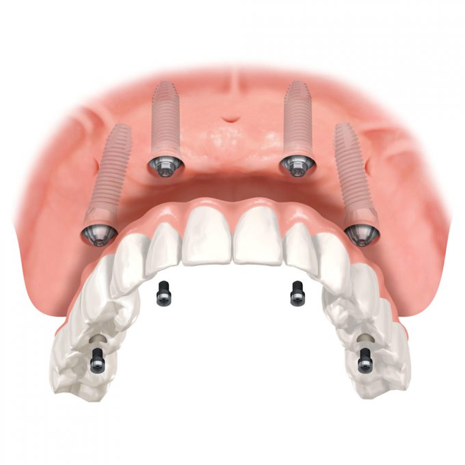 Implantologia- Studio dentistico Di Conza Foggia
