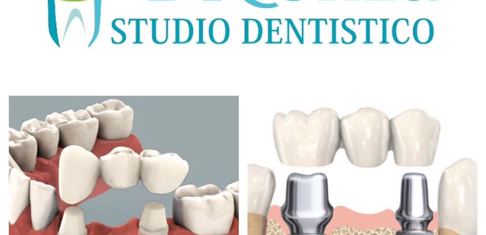 differenza tra ponte su denti naturali e ponte su impianti dentali
