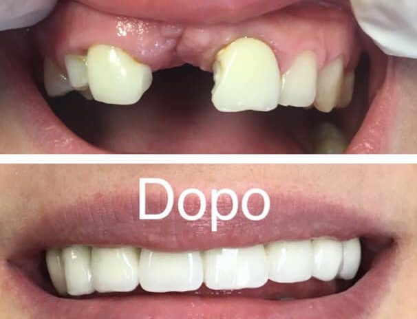 Riabilitazione estetica e funzionale in ceramica dell’arcata dentale superiore