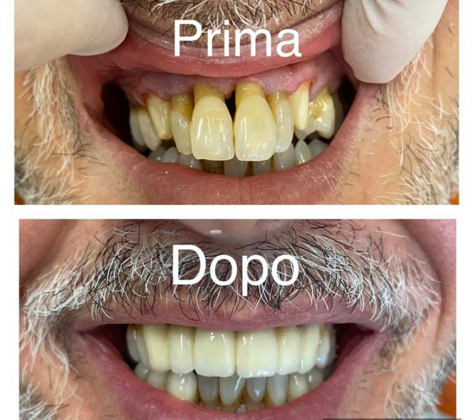 Capsule in ceramica nell’arcata superiore dentale