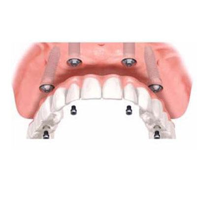 implantologia dentale Foggia