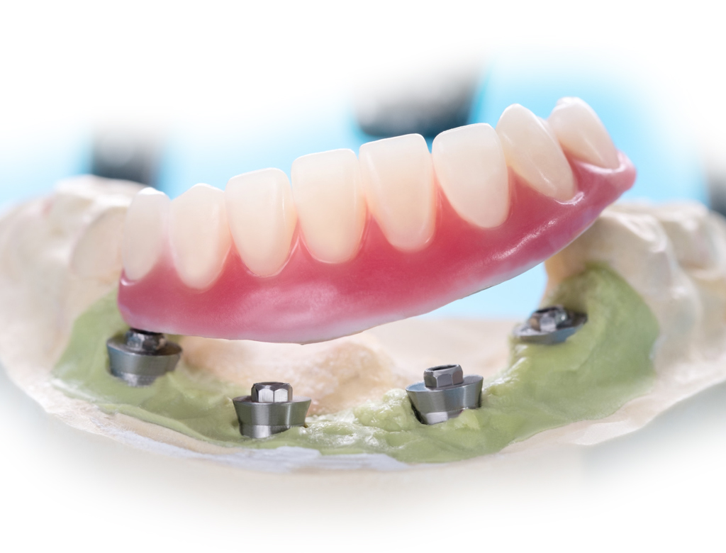 Uso delle resine per protesi dentali digitali